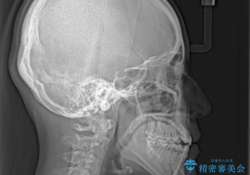 【モニター】上顎が狭い 急速拡大装置を用いたデコボコの解消の治療前