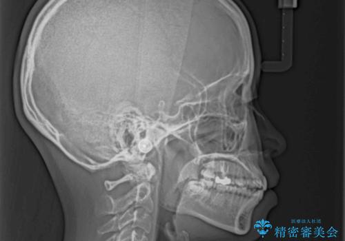 【モニター】口が閉じにくい 膨らんだ口元を抜歯矯正ですっきりとの治療前