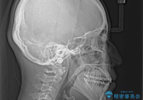 【モニター】上顎が狭い　急速拡大装置を用いたデコボコの解消の治療後