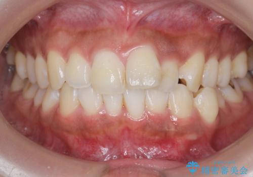 出っ歯感のある前歯を治したい、抜歯をしないマウスピース矯正の治療前