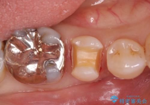口を開けると銀歯が見えるのが嫌だ。の治療中
