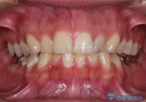 【インビザライン】虫歯の多い方の矯正治療の症例 治療前