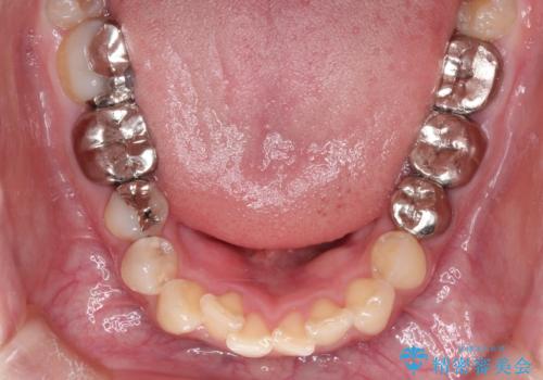 【インビザライン】虫歯の多い方の矯正治療の治療前