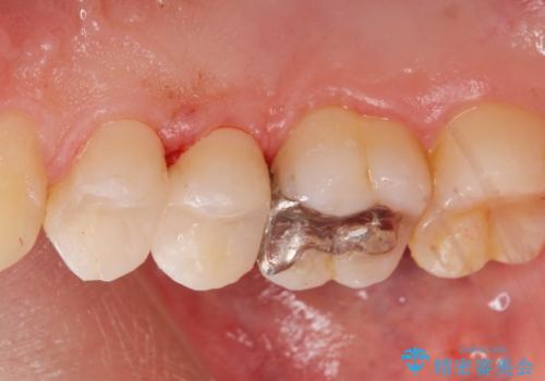 虫歯治療の治療後