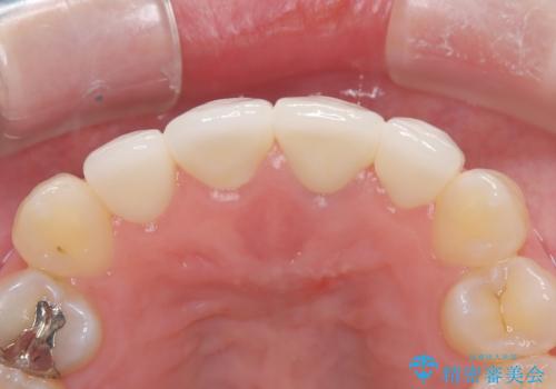 前歯の色が気になる【オールセラミッククラウン】の治療後