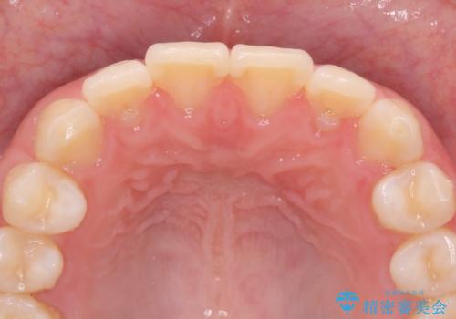 [ インビザラインライト ]   14枚で行う前歯のみの短期間マウスピース矯正の症例 治療後