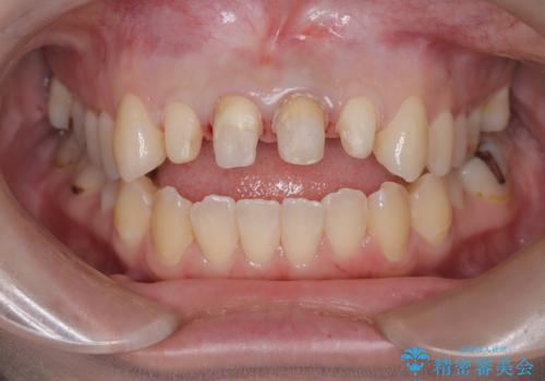 前歯の色が気になる【オールセラミッククラウン】の治療中