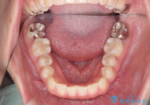 [ インビザラインライト ]   14枚で行う前歯のみの短期間マウスピース矯正の治療後