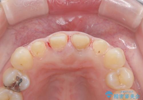 前歯の色が気になる【オールセラミッククラウン】の治療中