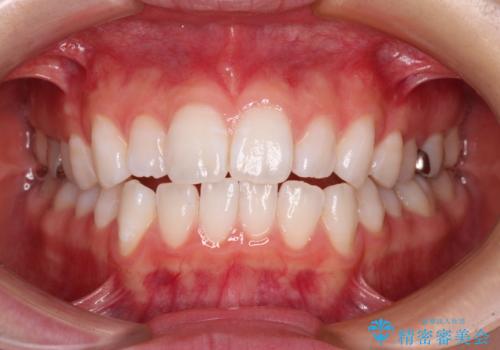 【モニター】口が閉じにくい 膨らんだ口元を抜歯矯正ですっきりとの治療前