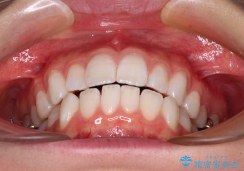 【モニター】口が閉じにくい 膨らんだ口元を抜歯矯正ですっきりとの治療前