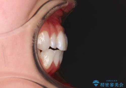 【モニター】口が閉じにくい 膨らんだ口元を抜歯矯正ですっきりとの治療前