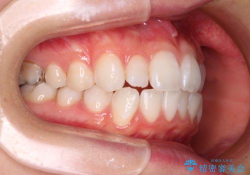 【モニター】口が閉じにくい 膨らんだ口元を抜歯矯正ですっきりとの治療前