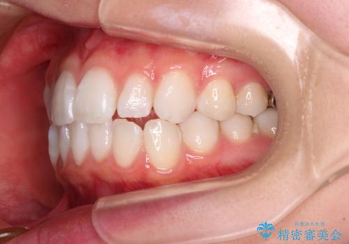 【モニター】口が閉じにくい 膨らんだ口元を抜歯矯正ですっきりとの治療前