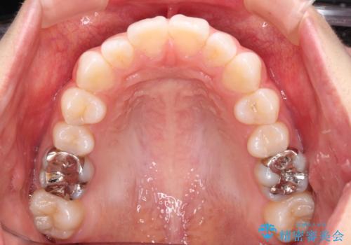 【モニター】口が閉じにくい 膨らんだ口元を抜歯矯正ですっきりとの治療前