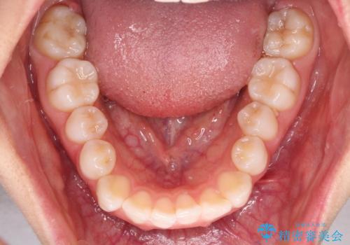 【モニター】口が閉じにくい 膨らんだ口元を抜歯矯正ですっきりとの治療前