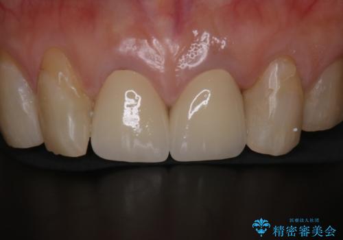 前歯の着色が気になる(失活歯)の症例 治療後