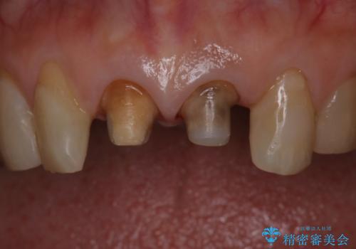 前歯の着色が気になる(失活歯)の治療中