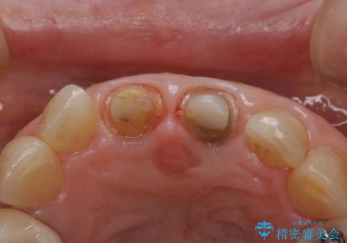 前歯の着色が気になる(失活歯)の治療後