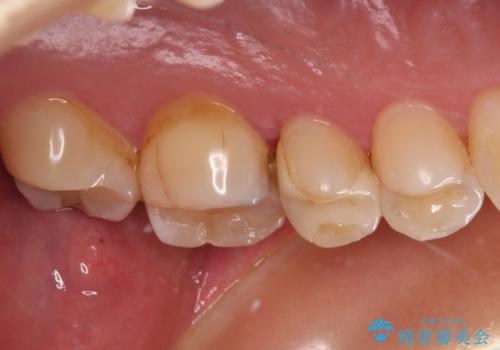 上下の歯が接触するだけで痛い 根管治療とオールセラミック治療の治療前