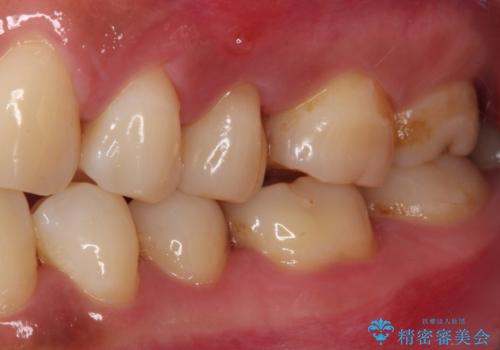 上下の歯が接触するだけで痛い 根管治療とオールセラミック治療の治療前