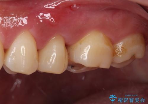 上下の歯が接触するだけで痛い 根管治療とオールセラミック治療の治療前