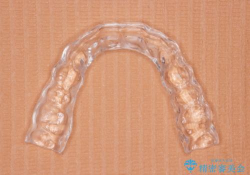 ナイトガードによる歯の予防の治療後