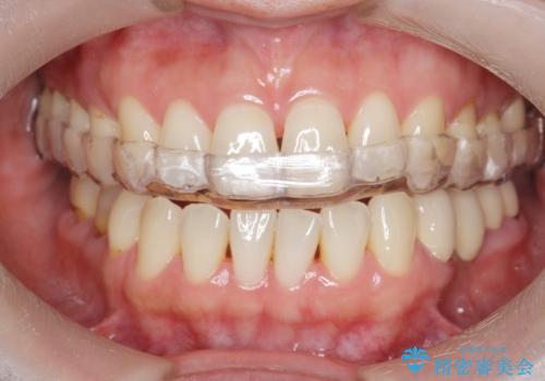 ナイトガードによる歯の予防の症例 治療後