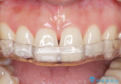 ナイトガードによる歯の予防の治療後