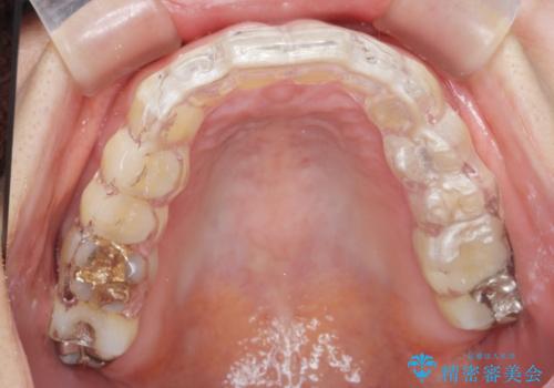 ナイトガードによる歯の予防の治療後