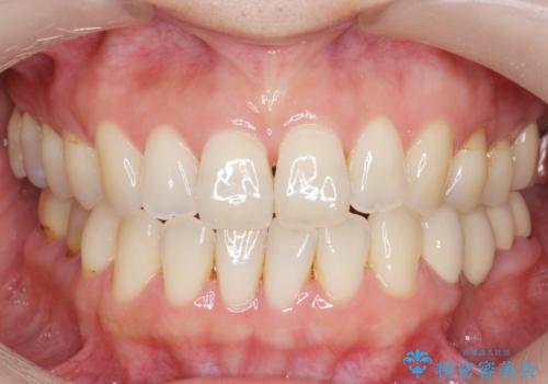 ナイトガードによる歯の予防の症例 治療前