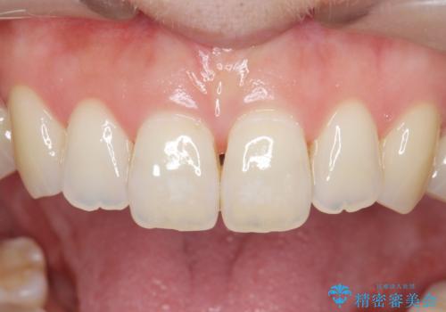 ナイトガードによる歯の予防の治療前