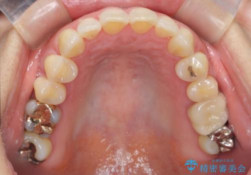 ナイトガードによる歯の予防の治療前