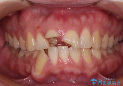 転んで欠けてしまった前歯 抜歯を回避してオールセラミッククラウンで審美回復の治療前