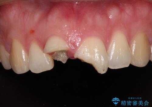 転んで欠けてしまった前歯 抜歯を回避してオールセラミッククラウンで審美回復の治療前