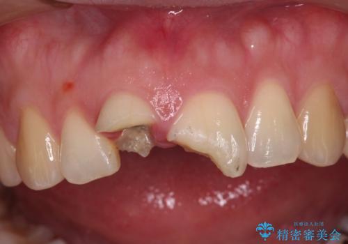 転んで欠けてしまった前歯 抜歯を回避してオールセラミッククラウンで審美回復の治療前