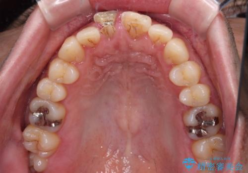 転んで欠けてしまった前歯 抜歯を回避してオールセラミッククラウンで審美回復の治療前