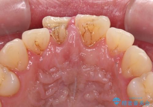 転んで欠けてしまった前歯 抜歯を回避してオールセラミッククラウンで審美回復の治療前