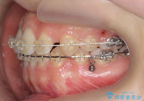 かみ合わせが悪いところを ワイヤー矯正でしっかり治療 マウスピース矯正は難しい症例の治療中