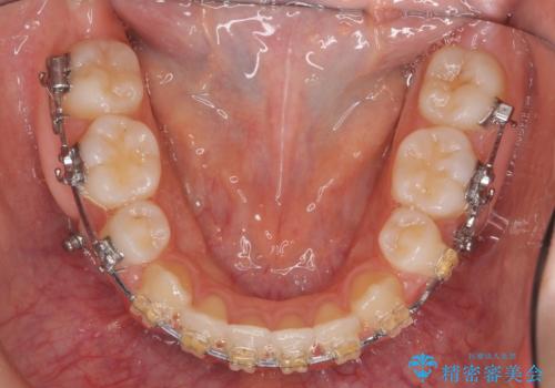 かみ合わせが悪いところを ワイヤー矯正でしっかり治療 マウスピース矯正は難しい症例の治療中