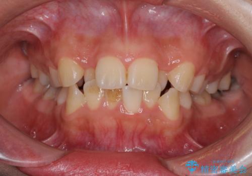 デコボコと膨らんだ口元　ハーフリンガルによる抜歯矯正とインプラント補綴治療の治療前