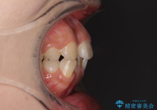 デコボコと膨らんだ口元 ハーフリンガルによる抜歯矯正とインプラント補綴治療の治療前
