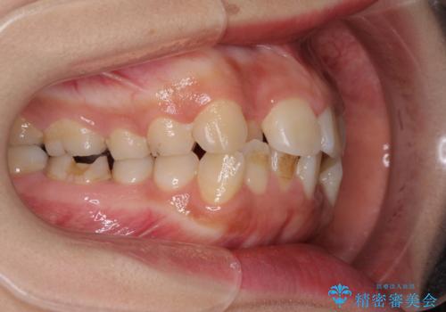 デコボコと膨らんだ口元 ハーフリンガルによる抜歯矯正とインプラント補綴治療の治療前