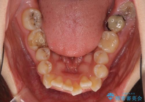 デコボコと膨らんだ口元　ハーフリンガルによる抜歯矯正とインプラント補綴治療の治療前