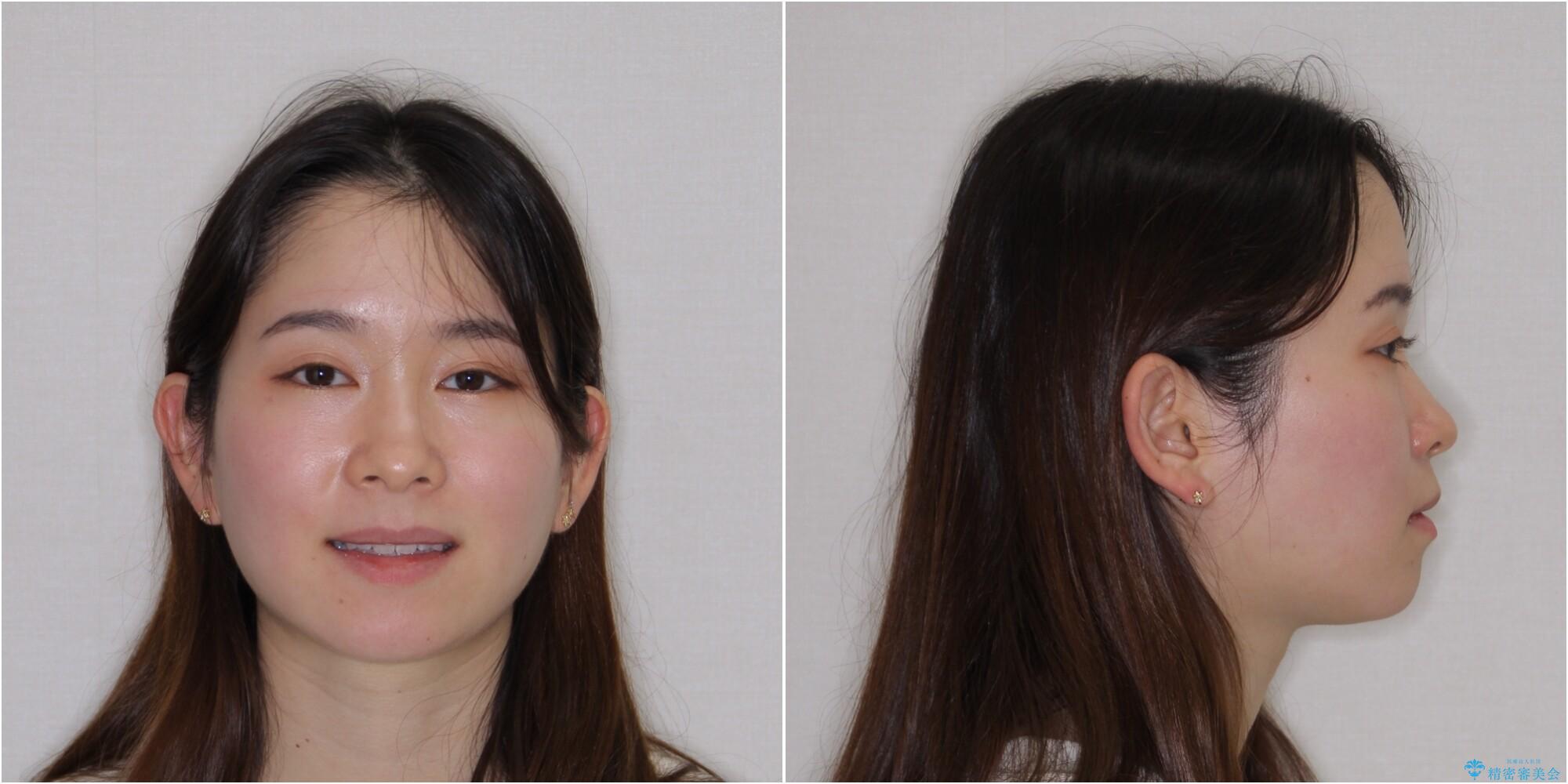 【モニター】口が閉じにくい 膨らんだ口元を抜歯矯正ですっきりとの治療後(顔貌)