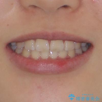 重度叢生と埋もれた奥歯 8本を抜歯したワイヤー矯正の治療後(顔貌)