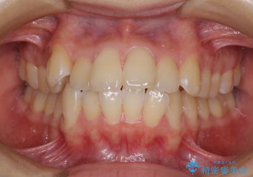口が閉じにくい 目立たないワイヤー装置で口元をすっきりとの症例 治療前