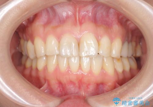 [ マウスピース矯正 ]  歯並びのずれが気になるの症例 治療後