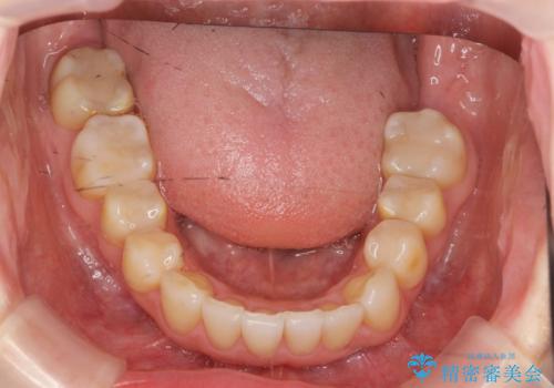 [ マウスピース矯正 ]  歯並びのずれが気になるの治療後