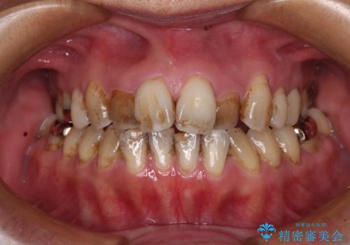 前歯の後戻り　インビザラインでの再矯正治療の症例 治療前